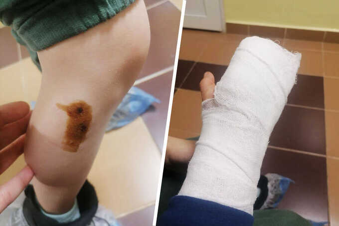 На Камчатке бойцовая собака откусила восьмилетнему мальчику палец